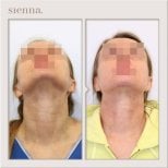 Résultats lifting du cou avant/après à Sienna Clinic, peau raffermie et contour amélioré