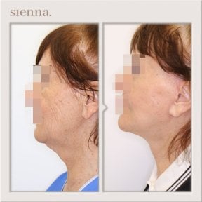 Résultats lifting visage avant/après à Sienna Clinic, peau du visage et cou raffermie
