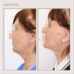 Résultats lifting visage avant/après à Sienna Clinic, peau du visage et cou raffermie