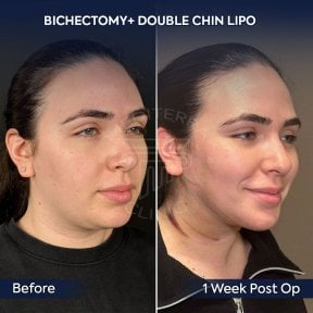 before-after photo mentoplastika-plastika-podborodka