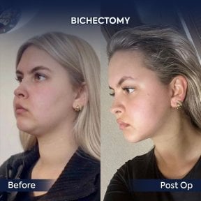 before-after photo mentoplastika-plastika-podborodka