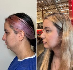 before-after photo mentoplastika-plastika-podborodka