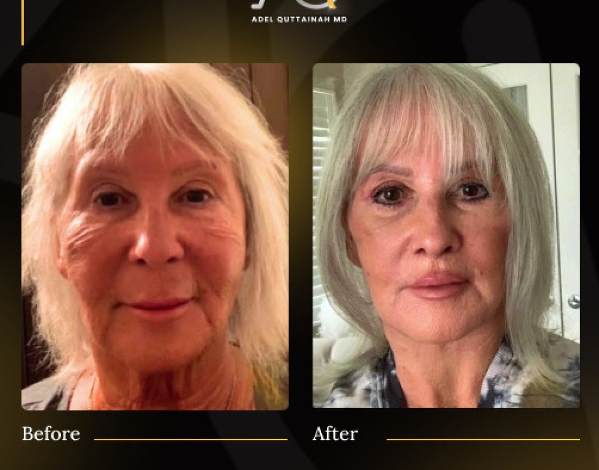 Resultados de lifting facial antes y después en Adel Quttainah MD – rejuvenecimiento facial