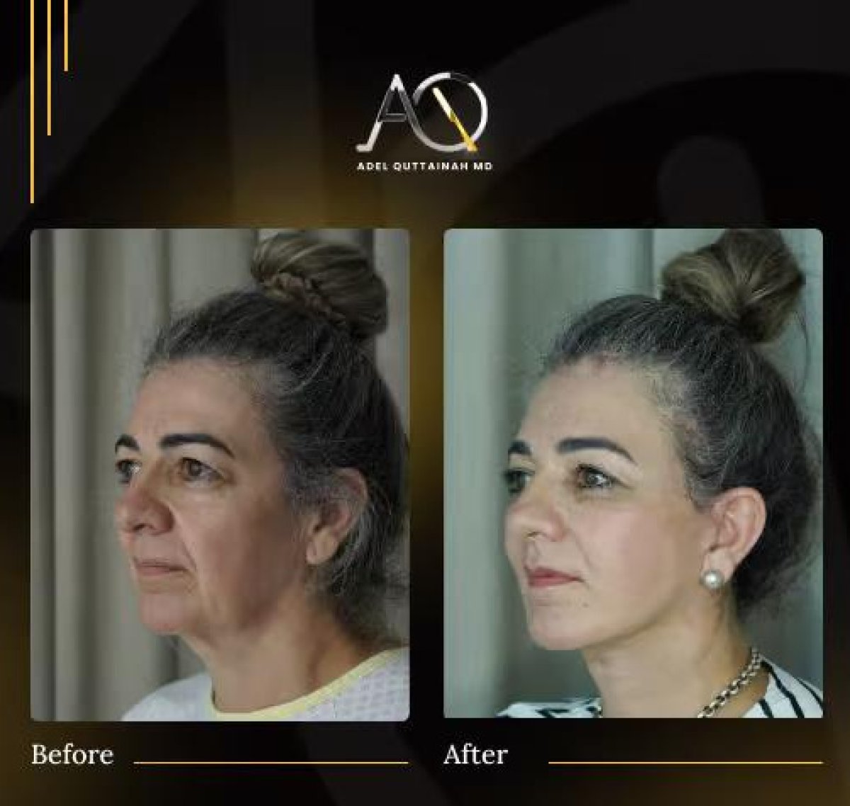 نتائج شد الوجه قبل وبعد في عيادة Adel Quttainah MD – تجديد شباب الوجه