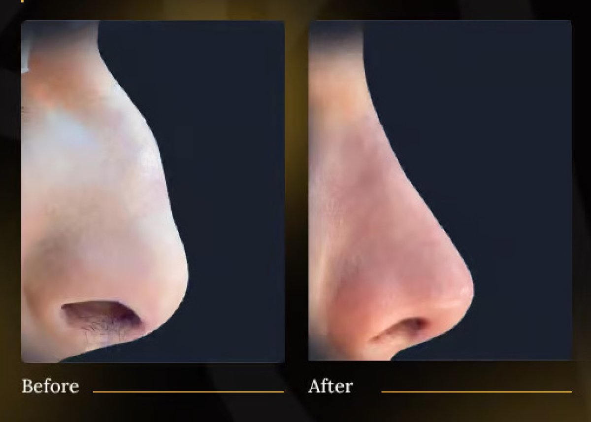 نتائج عملية تجميل الأنف قبل وبعد – إعادة تشكيل الأنف وتحسين المظهر الجانبي