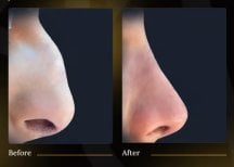 Resultados de rinoplastia antes y después: remodelación nasal y perfil mejorado