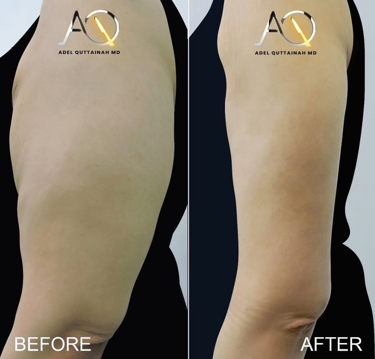 Resultados de lifting de brazos antes y después en Adel Quttainah MD – contorno mejorado