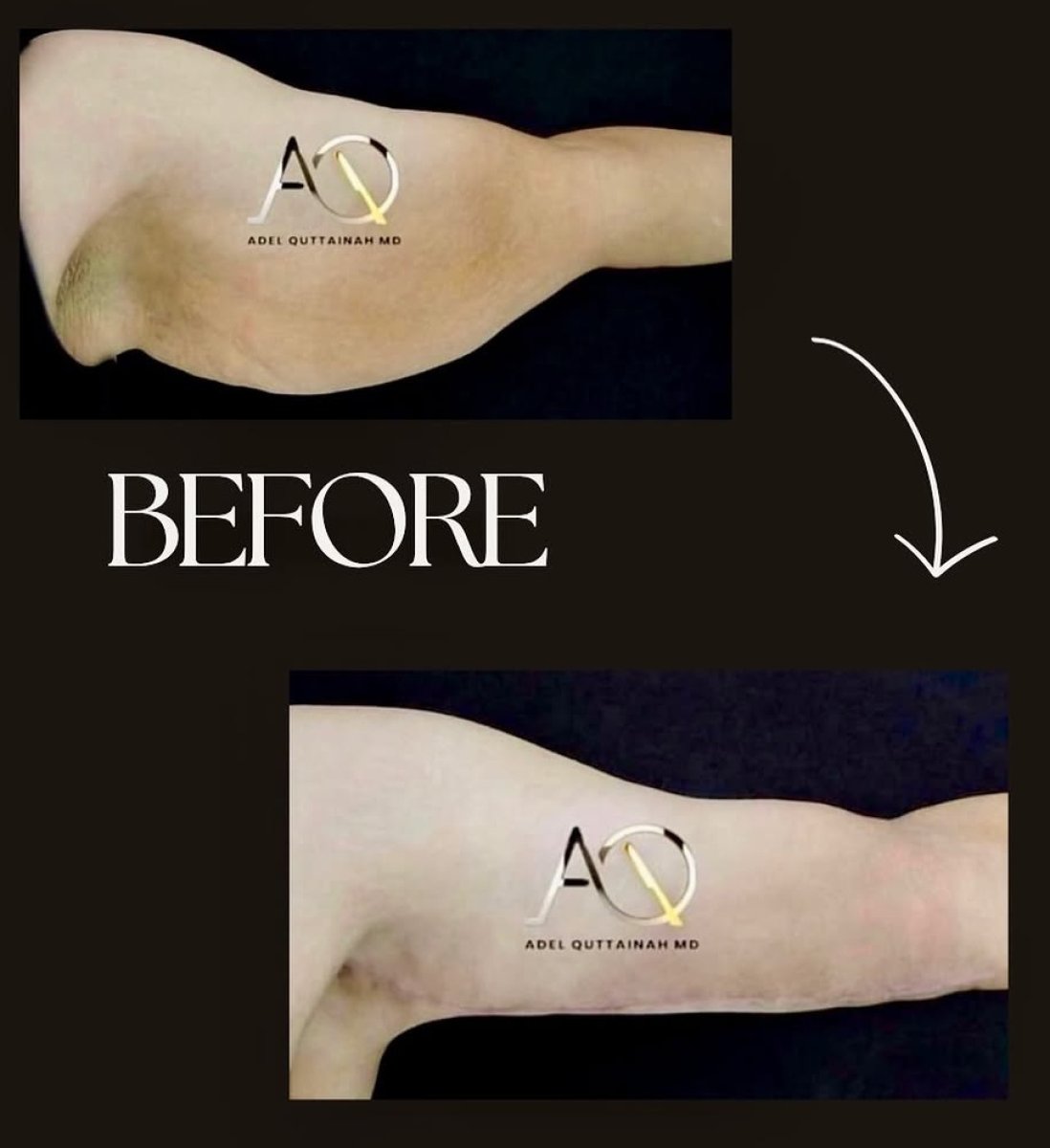 Resultados de lifting de brazos antes y después en Adel Quttainah MD, contorno mejorado