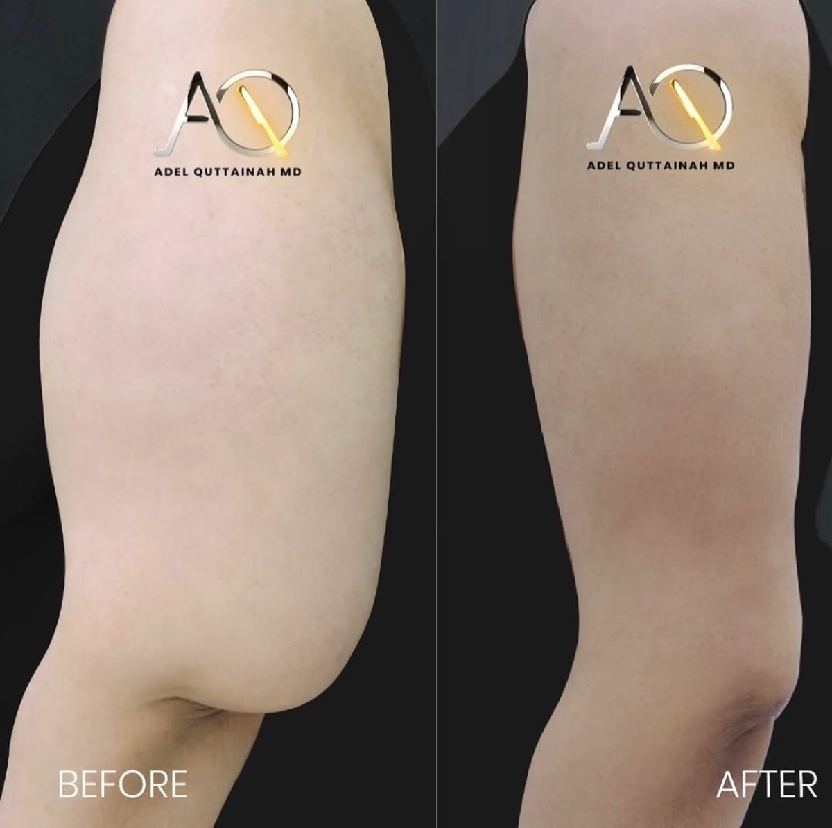 Resultados de lifting de brazos (braquioplastia) antes y después en Adel Quttainah MD – mejor contorno