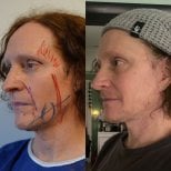 Before and after deep plane facelift results at Dr. Safa Manav Clinic, visible facial lift