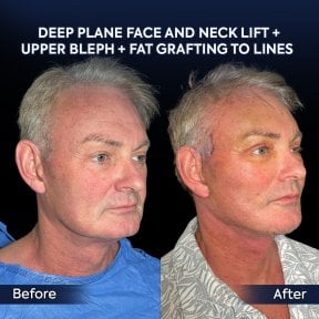 Before and after deep plane facelift and neck lift results at Dr. Safa Manav Clinic