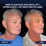 Before and after deep plane facelift and neck lift results at Dr. Safa Manav Clinic