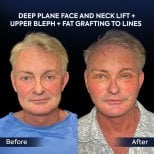 Before and after deep plane facelift, neck lift, and fat grafting results at Dr. Safa Manav Clinic