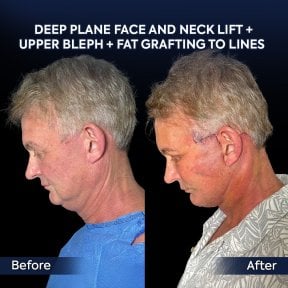 Before and after deep plane facelift and neck lift results at Dr. Safa Manav Clinic
