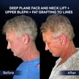 Before and after deep plane facelift and neck lift results at Dr. Safa Manav Clinic