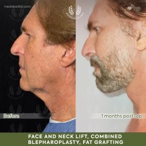 Before and after deep plane facelift results at Dr. Safa Manav Clinic, visible facial rejuvenation