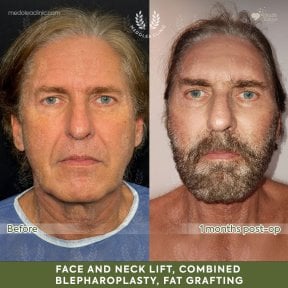 Before and after deep plane facelift results at Dr. Safa Manav Clinic, visible facial rejuvenation