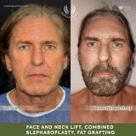 Before and after deep plane facelift results at Dr. Safa Manav Clinic, visible facial rejuvenation