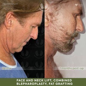 Before and after deep plane facelift results at Dr. Safa Manav Clinic, visible neck lift improvement