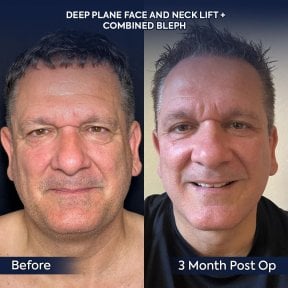 Before and after deep plane facelift and neck lift results at Dr. Safa Manav Clinic
