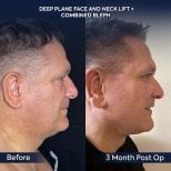 Before and after deep plane facelift and neck lift results at Dr. Safa Manav Clinic