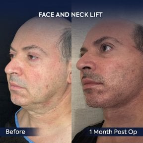 Before and after deep plane facelift and neck lift results at Dr. Safa Manav Clinic