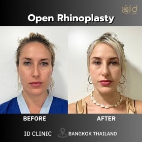 Résultats avant/après rhinoplastie ouverte à ID Clinic Bangkok, amélioration du nez