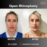 Résultats avant/après rhinoplastie ouverte à ID Clinic Bangkok, amélioration du nez