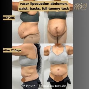 Résultats avant et après liposuccion vaser et abdominoplastie à ID Clinic Bangkok, ventre plat