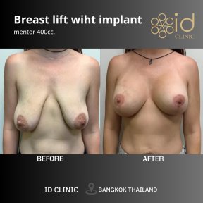 Avant-après lifting mammaire avec implants 400cc à ID Clinic Bangkok, forme améliorée