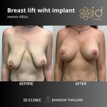 Avant-après lifting mammaire avec implants 400cc à ID Clinic Bangkok, forme améliorée