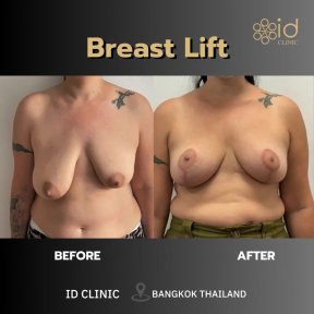 Résultats avant et après lifting mammaire à ID Clinic Bangkok, contour et fermeté améliorés