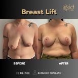 Résultats avant et après lifting mammaire à ID Clinic Bangkok, contour et fermeté améliorés