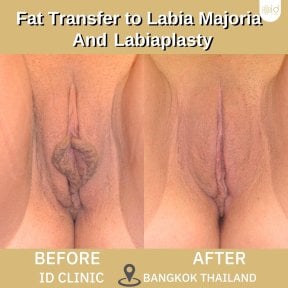Résultats avant et après labiaplastie et lipofilling des grandes lèvres à ID Clinic Bangkok
