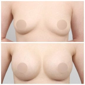 Resultados antes y después de lifting de senos en AB Plastic Surgery – mejor forma y elevación
