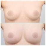 Resultados de levantamiento de senos antes y después en AB Plastic Surgery – mejor forma