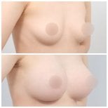Resultados de elevación de senos antes y después en AB Plastic Surgery – mejor forma y elevación