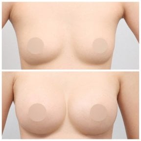Resultados de elevación de senos antes y después en AB Plastic Surgery – forma mejorada