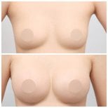 Resultados de elevación de senos antes y después en AB Plastic Surgery – forma mejorada