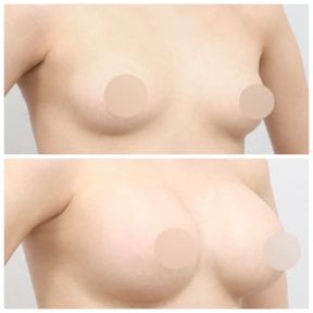 Resultados de lifting de senos antes y después en AB Plastic Surgery – mejora visible