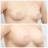 Resultados de lifting de senos antes y después en AB Plastic Surgery – mejora visible