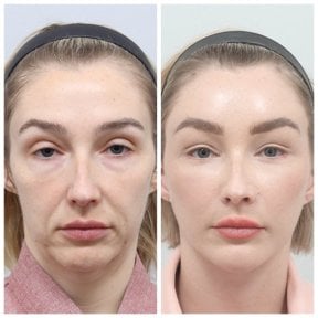 Resultados de lifting facial antes y después en AB Plastic Surgery – rejuvenecimiento visible