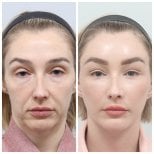 Resultados de lifting facial antes y después en AB Plastic Surgery – rejuvenecimiento visible