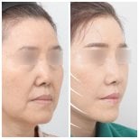 Antes y después de blefaroplastia en AB Plastic Surgery, resultado visible de corrección de párpados