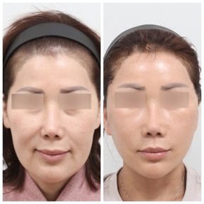 Resultados de blefaroplastia antes y después en AB Plastic Surgery, corrección de párpados
