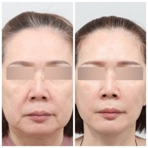 Resultados de blefaroplastia antes y después en AB Plastic Surgery, corrección de párpados