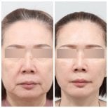 Resultados de blefaroplastia antes y después en AB Plastic Surgery, corrección de párpados