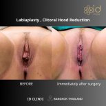 Résultats avant et après labiaplastie et réduction du capuchon clitoridien à ID Clinic Bangkok