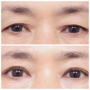 Resultados antes y después de blefaroplastia superior e inferior en AB Plastic Surgery, ojos rejuvenecidos