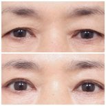 Resultados antes y después de blefaroplastia superior e inferior en AB Plastic Surgery, ojos rejuvenecidos